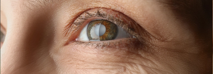 A close up image of a persons eye. Their eye is cloudy.